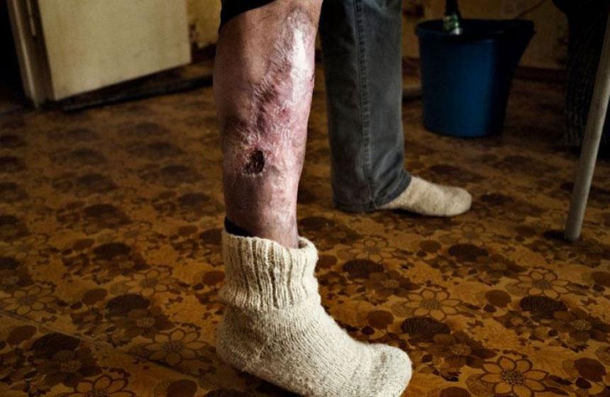 Droga Krokodil amenaza con convertirse en epidemia global