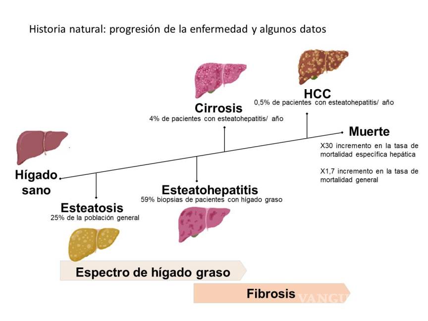 $!Gráfica cedida por el equipo de investigadores del CIMUS sobre la progresión de la fibrosis hepática.