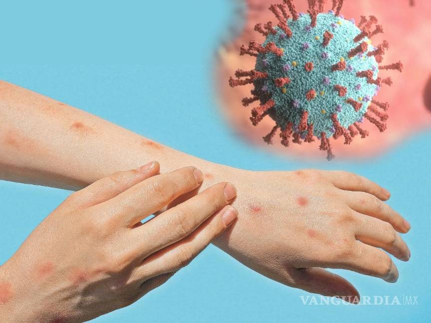 Viruela del mono en México... ¿Qué es, por qué no está disponible la vacuna y cuál es el tratamiento?