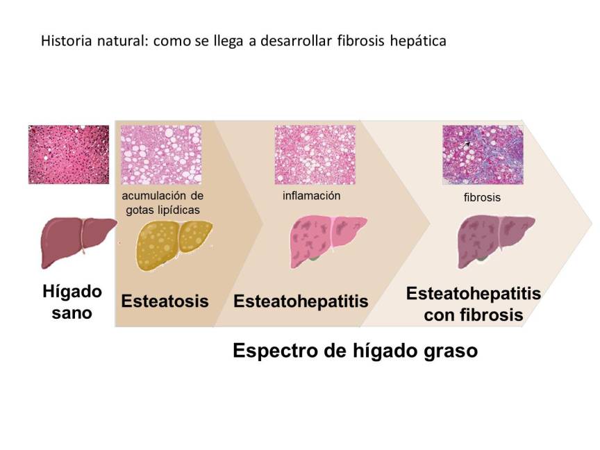 $!Gráfica cedida por el equipo de investigadores del CIMUS sobre cómo se llega a desarrollar la fibrosis hepática.