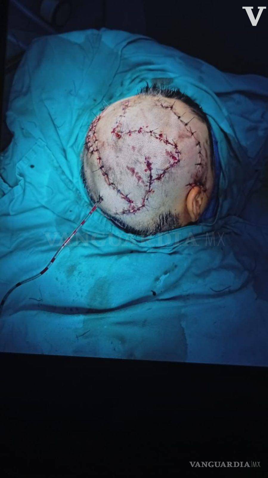 $!La menor se recupera satisfactoriamente tras una cirugía reconstructiva que requirió 68 puntos de sutura.