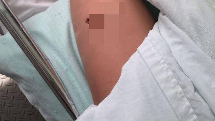 La menor fue trasladada al Hospital del ISSSTE de Monclova luego de que un lápiz se incrustara profundamente en su pierna tras una caída en el salón de clases.