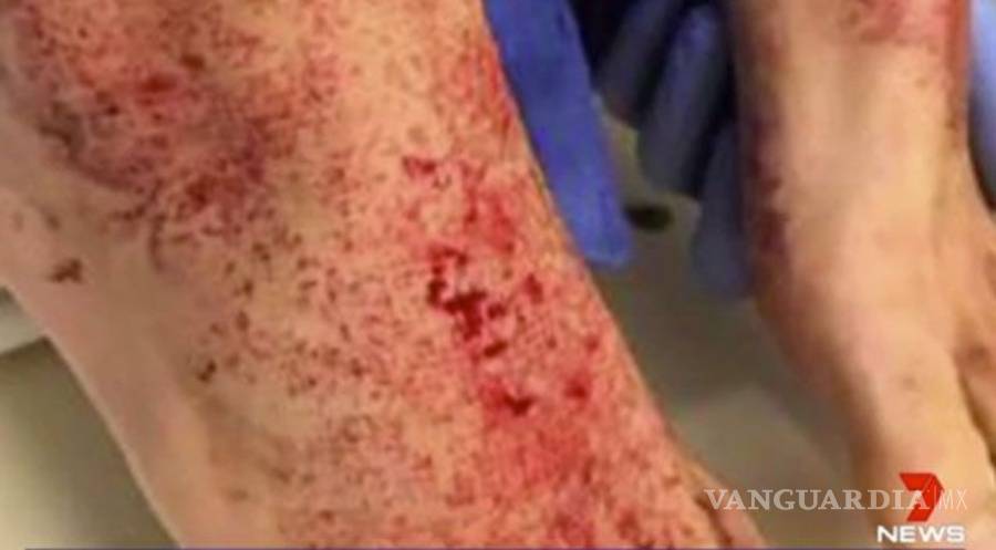 $!Misteriosas criaturas marinas causan heridas a joven en Australia