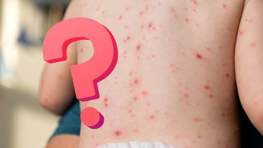 Conoce las diferencias entre sarampión y varicela, sus síntomas, contagio, riesgos y la importancia de la vacunación para prevenir brotes.