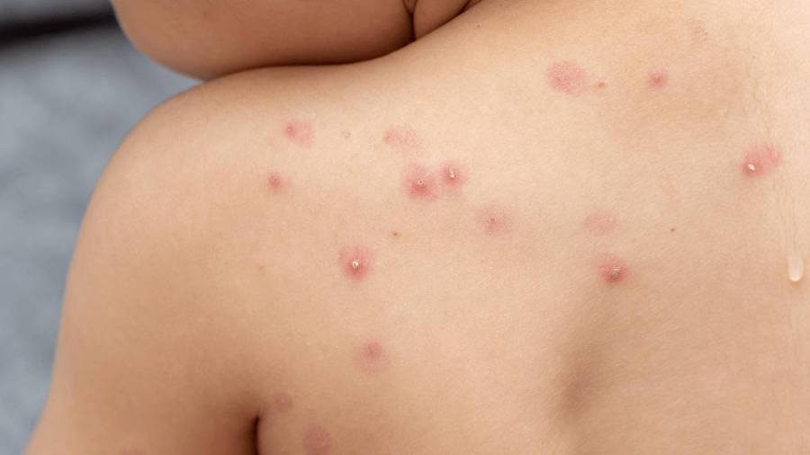 Con el balance nacional aún acotado y concentrado en pocas entidades, el seguimiento sanitario se mantiene activo.