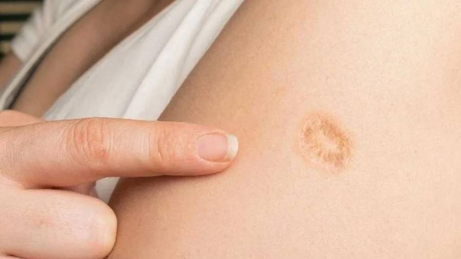 Claudia Sheinbaum aclara que la cicatriz en el hombro no es por la vacuna del sarampión, sino para otros padecimientos