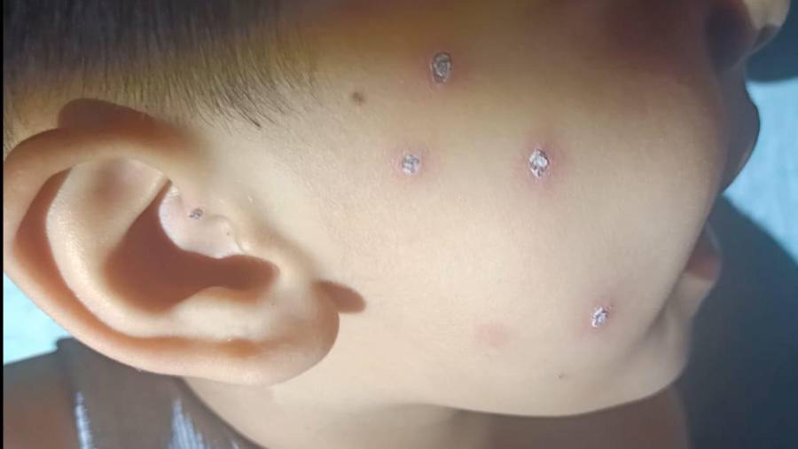El virus Coxsackie, también conocido como enfermedad de manos, pies y boca, ha sido detectado en niños de hasta 12 años en Parras, situación que ha generado preocupación entre autoridades escolares y familias de la región.
