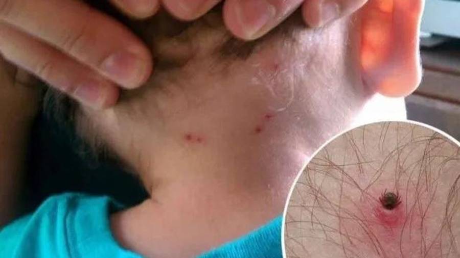 La rickettsiosis puede ser mortal cuando el diagnóstico y tratamiento se retrasan.