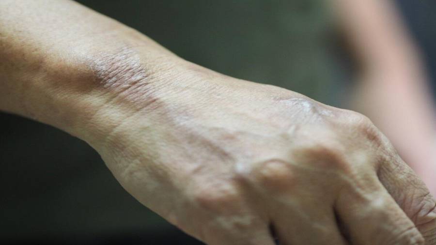 Señalan que el objetivo es evitar un repunte de lepra y cortar cadenas de transmisión.