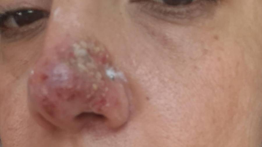 Alexandra N. Sufrió necrosis de nariz.