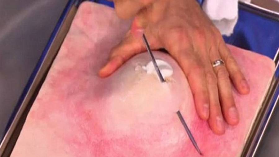 Médico explica cómo reventar un grano sin lastimar la piel