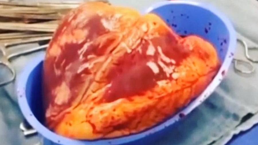 Corazón de cocainómano dejó de latir 25 minutos después de haber sido extirpado