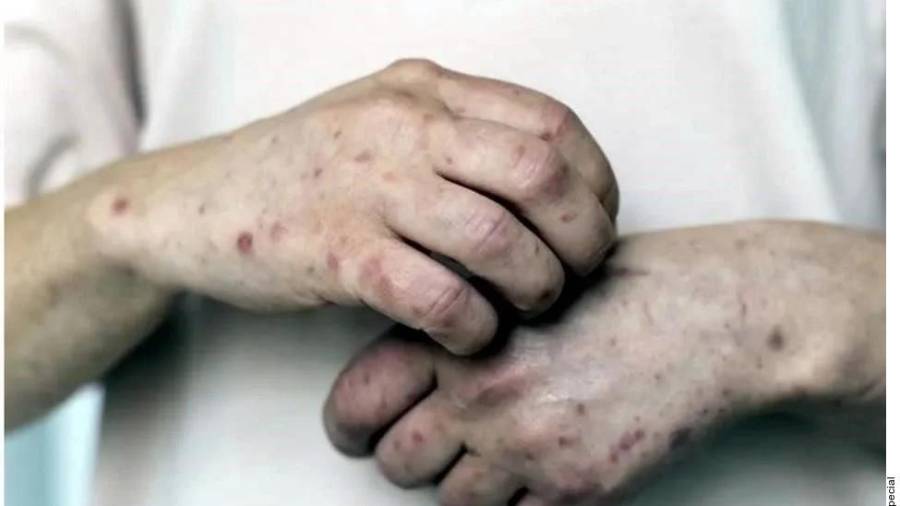 En la CDMX el brote de sarampión comenzó en agosto de 2025, cuando se confirmaron los primeros cinco contagios. Desde entonces y hasta la fecha, la Capital suma 158 contagios.