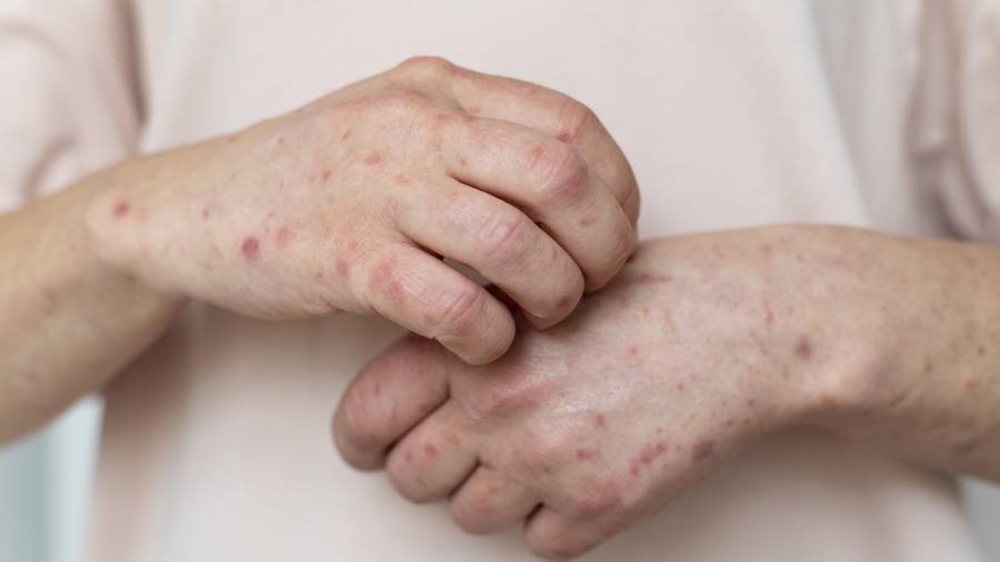 El sarpullido rojo y la fiebre alta son los principales signos de alerta; autoridades piden no automedicarse y acudir a consulta.