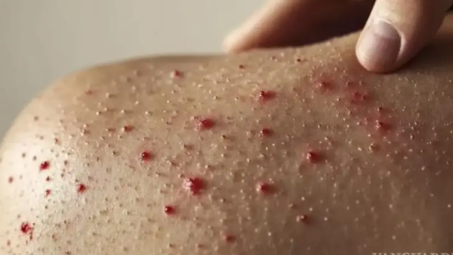 La Secretaría de Salud de Puebla confirmó la detección del primer caso de sarampión en el estado, por lo que reforzó la vigilancia epidemiológica de la mano del Gobierno estatal.