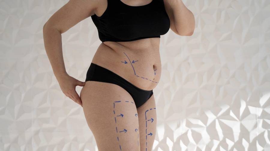 A menudo, las hinchazones producidas por el linfedema y el lipedema son confundidas la una con la otra y a su vez con la obesidad.