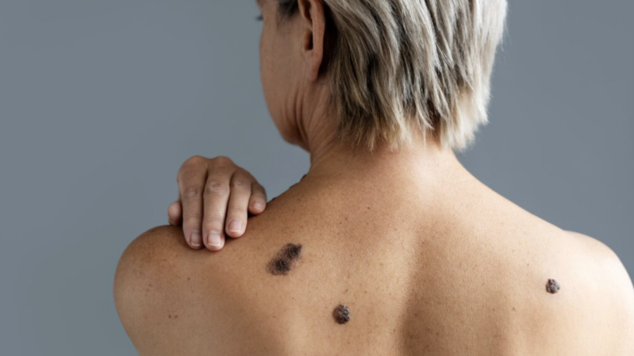 El cáncer de piel no afecta a todas las poblaciones de la misma manera.