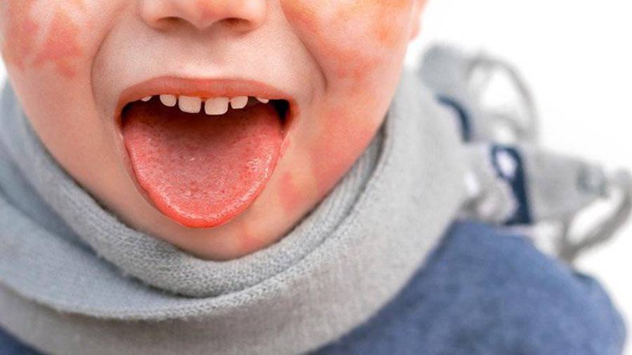 La conmemoración también busca reforzar que el tratamiento oportuno reduce de manera significativa el riesgo de complicaciones cardiacas.