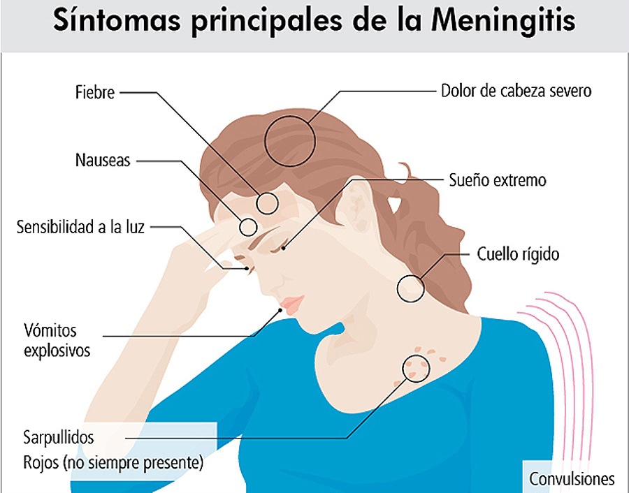 $!Desarrollan tratamiento “salvavidas” para la meningitis