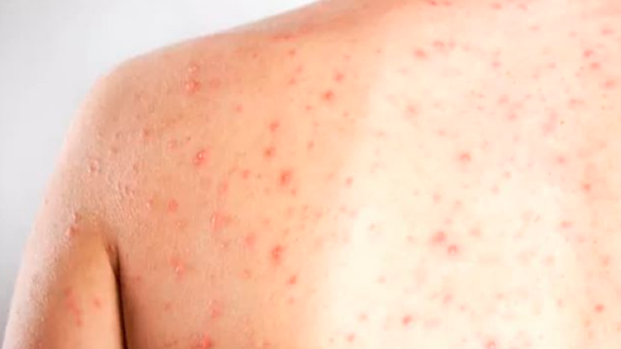 Autoridades sanitarias activaron monitoreo y cerco epidemiológico tras el caso vinculado con Allende.