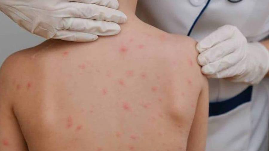 Un caso importado de sarampión cobró la vida de un menor en Durango, lo que llevó a las autoridades a reforzar el llamado urgente a la vacunación en personas de 6 meses a 49 años.