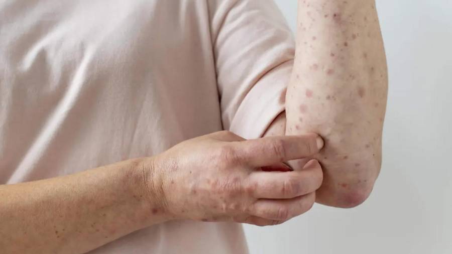 Los contagios se distribuyen en Torreón y Saltillo, con cuatro casos en cada ciudad.