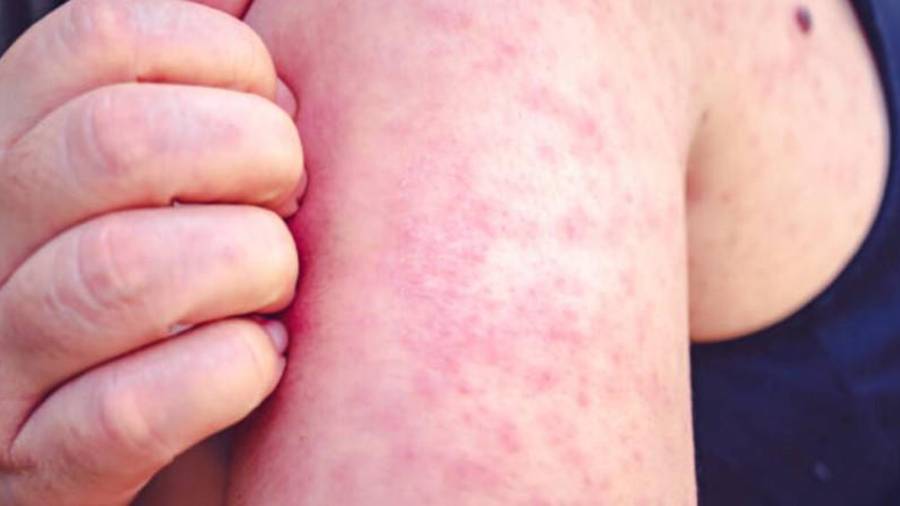 La detección del caso activó protocolos sanitarios en Acuña, aunque el contagio no se originó directamente en este municipio.