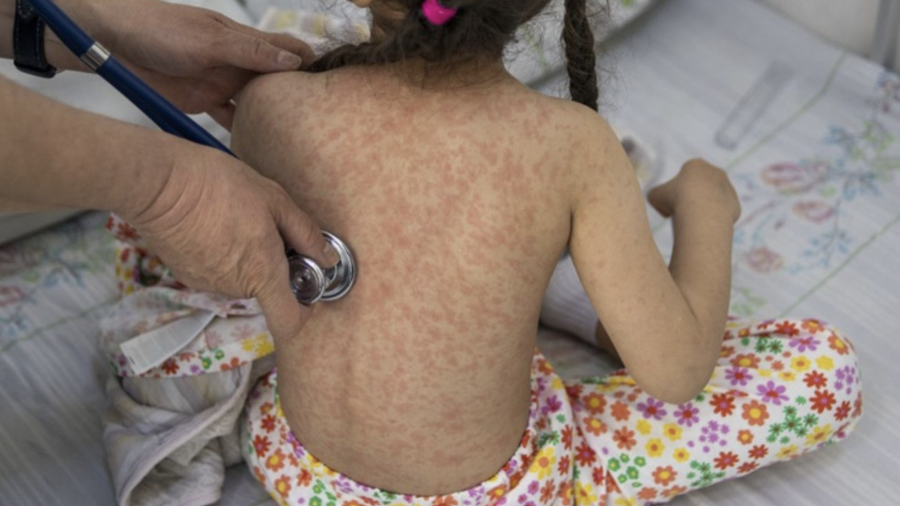 El sarampión es una enfermedad viral altamente contagiosa.