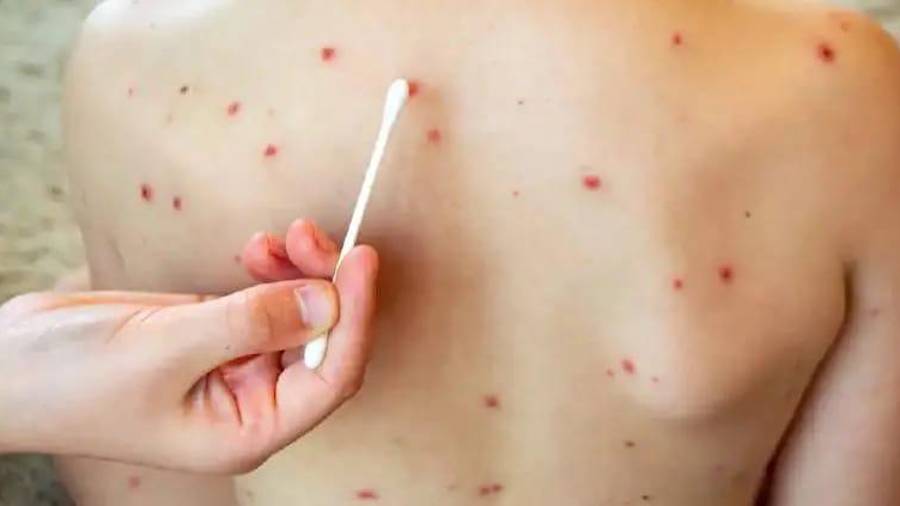 La Secretaría de Salud del Estado de Durango activó una alerta epidemiológica tras la confirmación de 17 contagios de sarampión, e intensificó las acciones preventivas para evitar la propagación del virus.