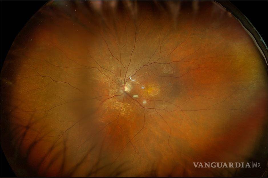 $!Médicos oftalmólogos de Miranza, grupo líder en oftalmología alertan sobre el impacto del tabaquismo en la salud ocular, especialmente en enfermedades degenerativas asociadas a la edad, mácula o zona central de la retina. Y recuerdan que dejar de lado el tabaco puede contribuir a reducir el avance del daño ocular y recomiendan realizar revisiones oftalmológicas periódicas, especialmente a partir de los 50 años o en personas con antecedentes familiares de enfermedades retinianas.