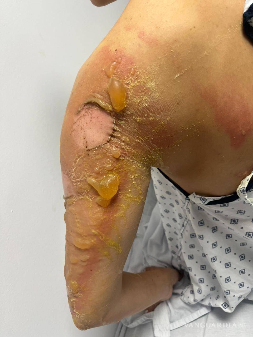 $!A través de redes sociales, se compartieron imágenes de asistentes que sufrieron quemaduras y lesiones.