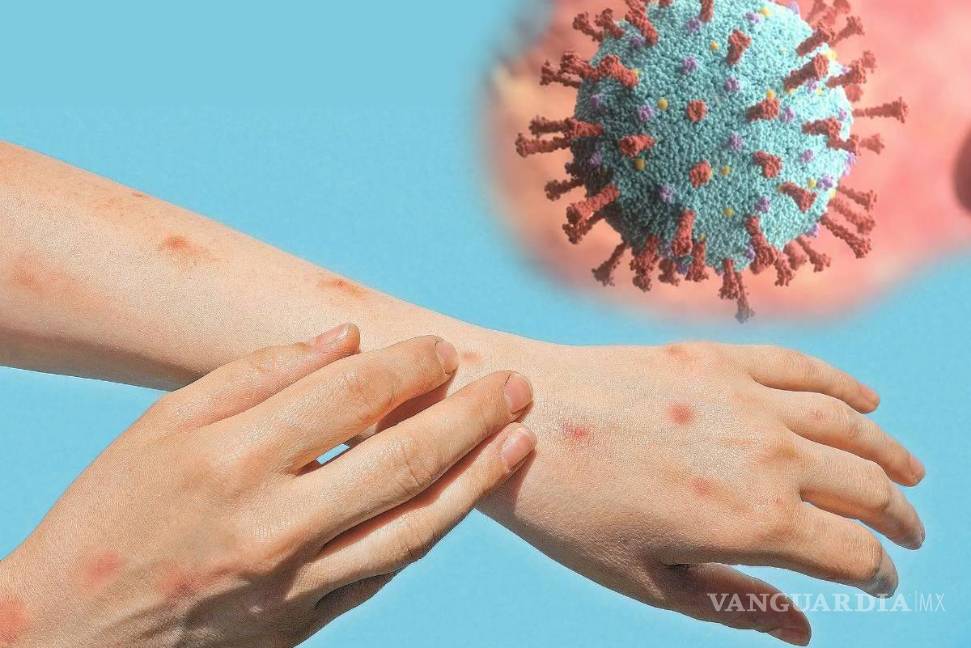 ¿Cuál es la diferencia entre mpox y la varicela? Joven mexicana las confunde y se vuelve viral