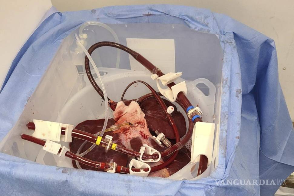 $!Cirujanos conectaron externamente el hígado de cerdo a un cuerpo humano con muerte cerebral y observaron cómo filtraba la sangre con éxito.