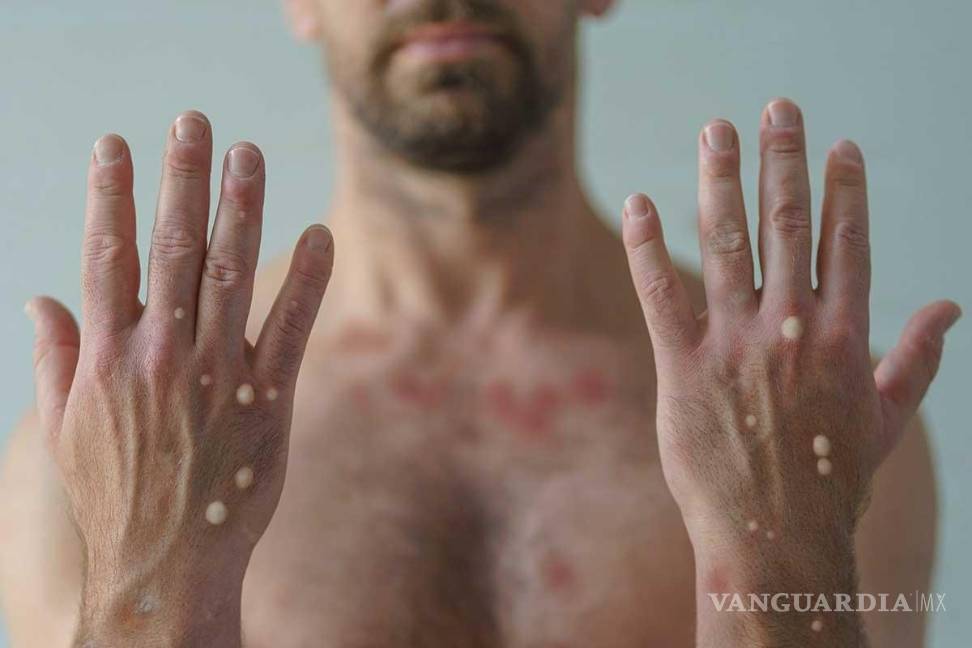 Hay riesgo de contagios por caso de viruela símica, dice Alcade de Monclova