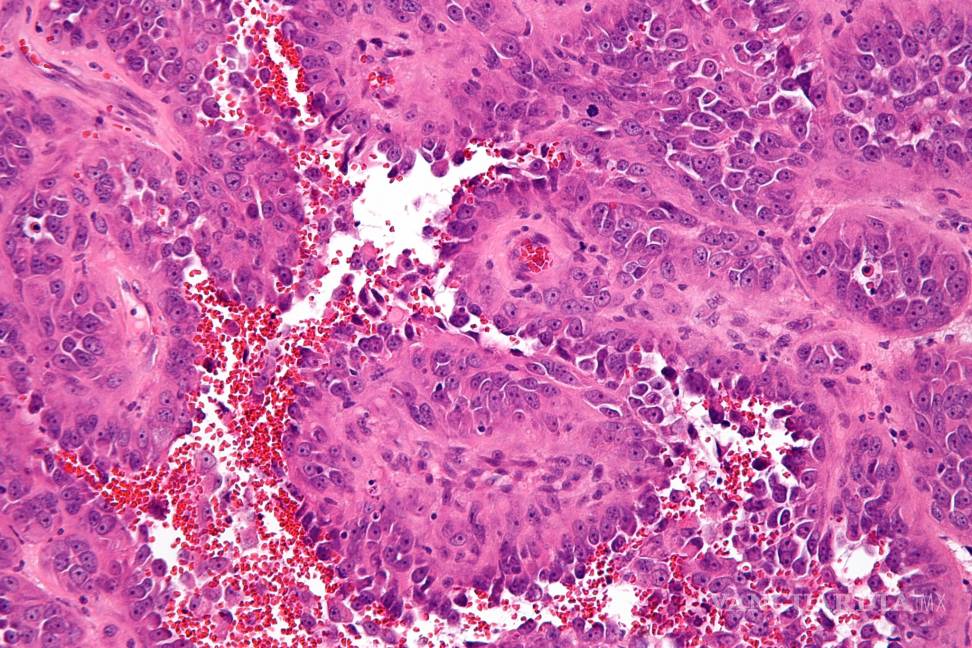 Estudio con pacientes de angiosarcoma revela posibles nuevas terapias