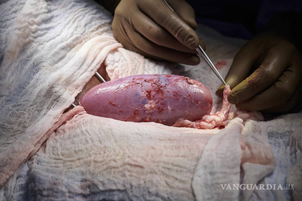 $!En esta foto de septiembre de 2021 proporcionada por NYU Langone Health, un equipo quirúrgico del hospital de Nueva York examina un riñón de cerdo adherido al cuerpo de un receptor fallecido en busca de signos de rechazo. AP/Joe Carrotta/NYU Langone Health