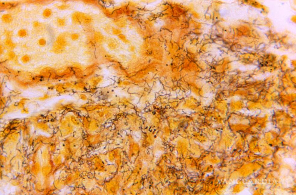 $!Fotografía de microscopio de 1966 se ve una muestra de tejido con la presencia de espiroquetas Treponema pallidum, la bacteria responsable de la sífilis.