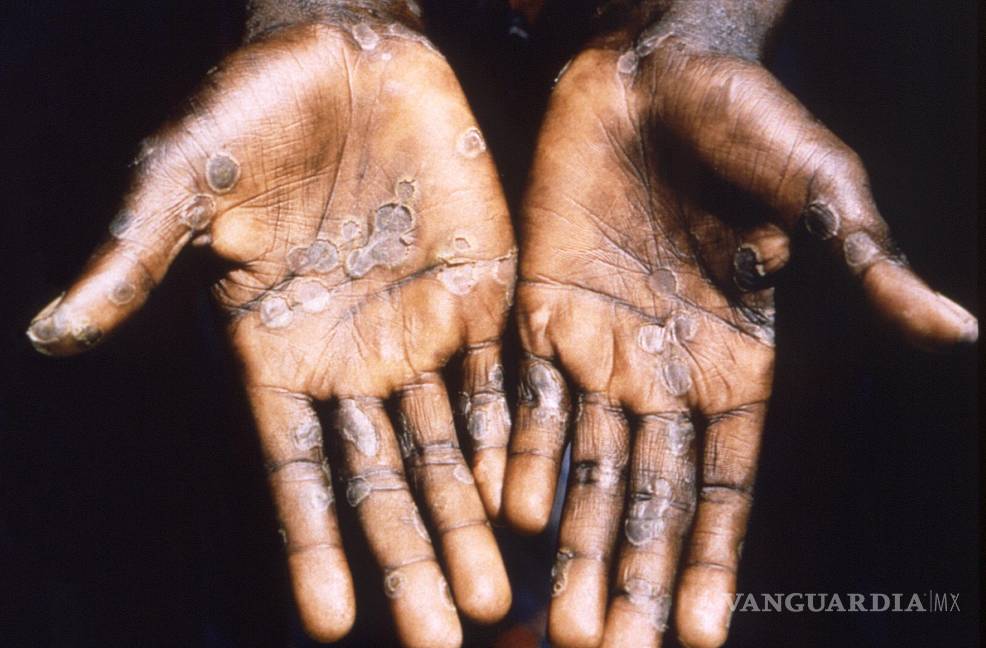 $!Imagen de las lesiones en la piel provocadas por la viruela del mono, durante un estudio llevado a cabo en la República Democrática del Congo entre 1996 y 1997.