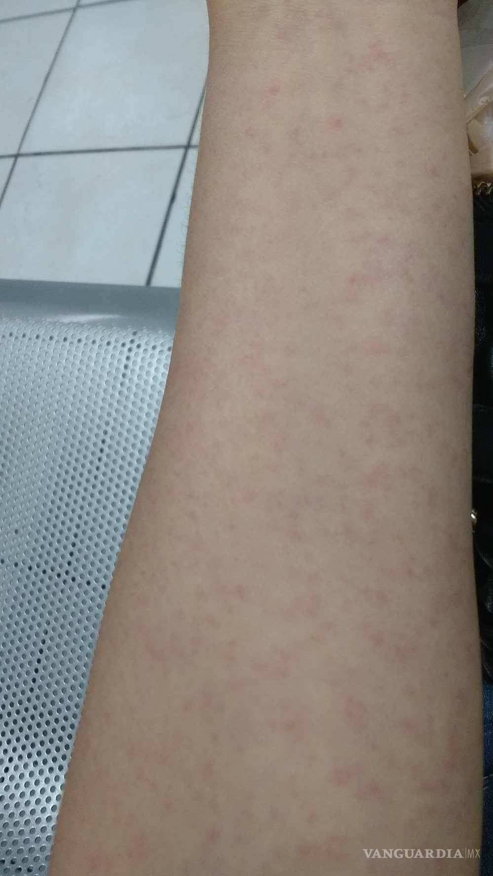 $!Atienden brote de zika en Monclova