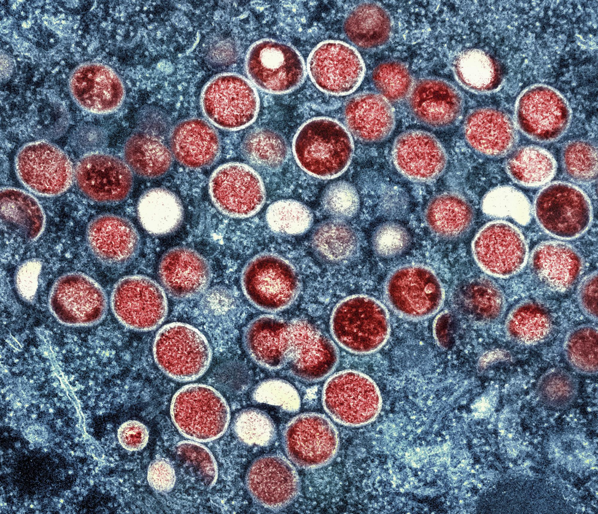 ¿Es la viruela símica una enfermedad de transmisión sexual?. Noticias en tiempo real