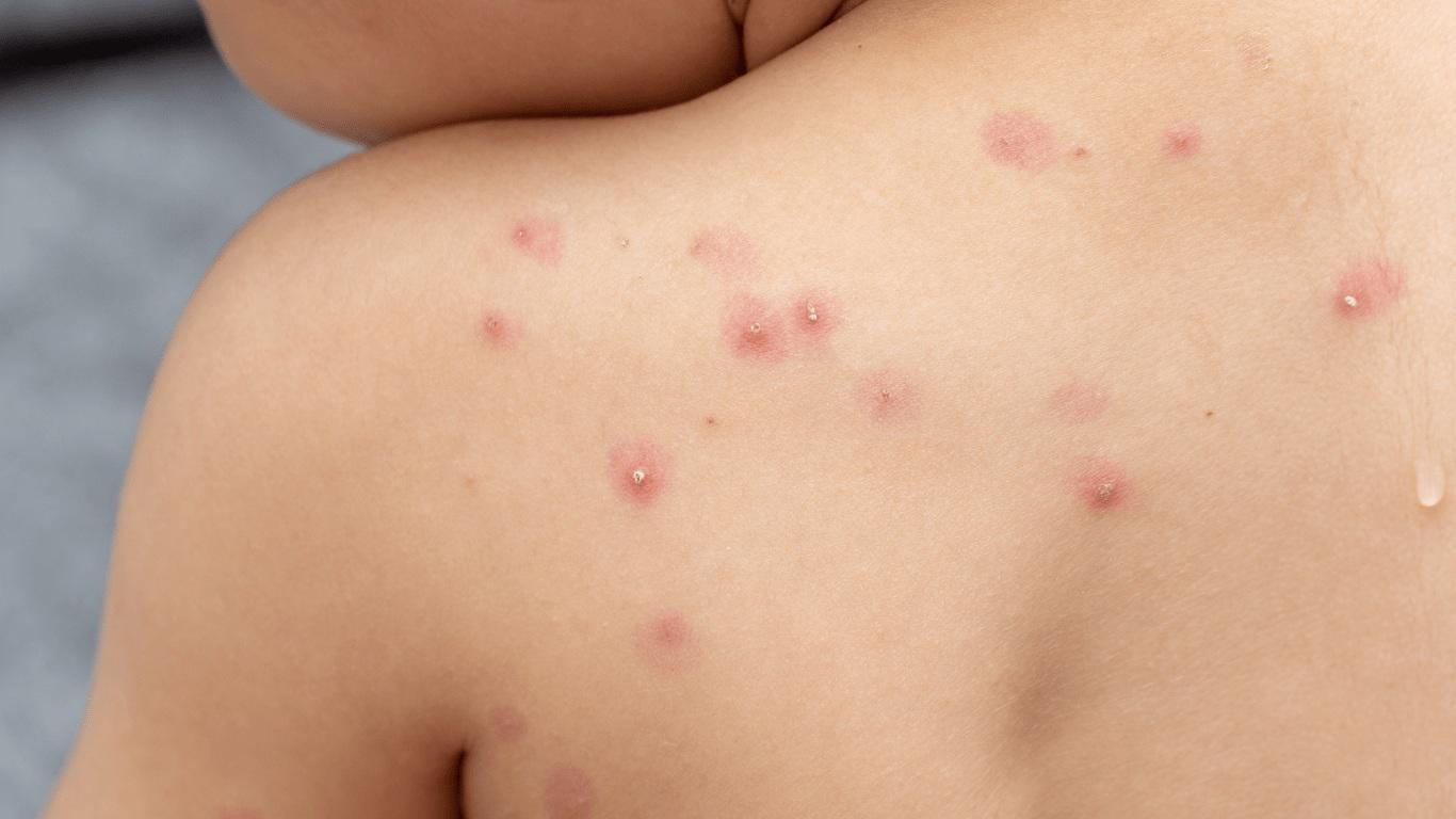 Nuevo caso de Mpox en Yucatán reactiva vigilancia; entidad ya suma cuatro contagios en 2026